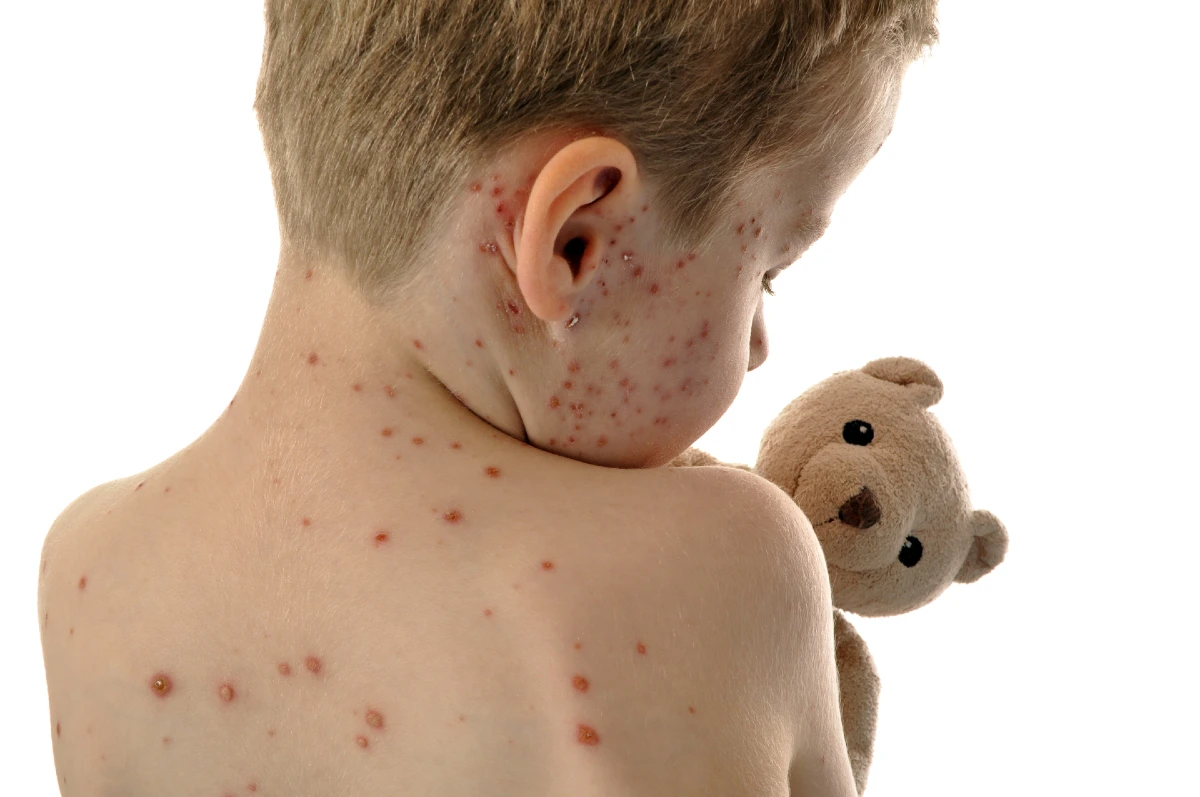 measles